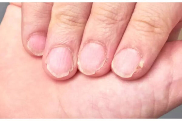 5 diseases that nails can reveal